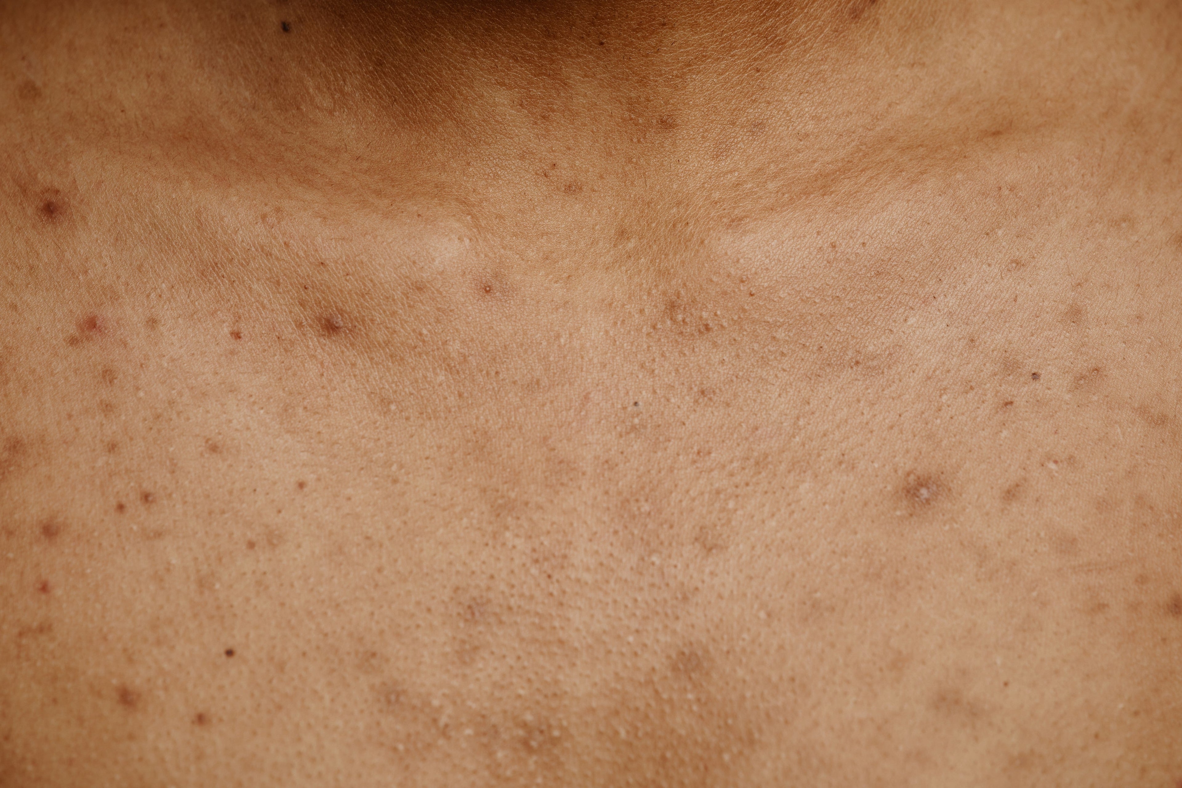 Are Acne Scars Permanent?